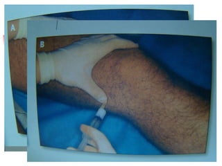 Ligamentos lateral interno y externo Aguja naranja Jeringa 2cc - 5cc 1 cc cort. depot 1 cc anestésico 