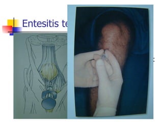 Entesitis tendón rotuliano Aguja naranja Jeringa 2cc - 5cc 0.5-1 cc cort. depot 0.5 cc anestésico 
