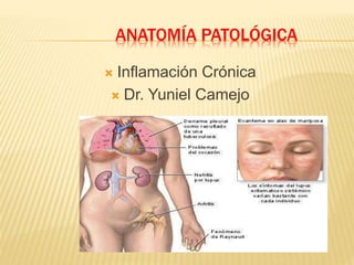ANATOMÍA PATOLÓGICA
 Inflamación Crónica
 Dr. Yuniel Camejo
 