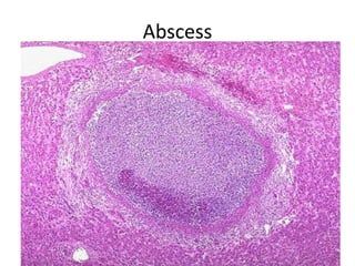 Abscess
 