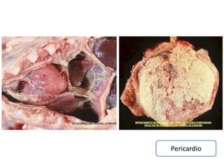 Pericardio
 