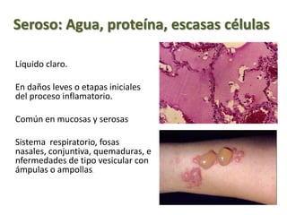 Seroso: Agua, proteína, escasas células
Líquido claro.
En daños leves o etapas iniciales
del proceso inflamatorio.
Común en mucosas y serosas
Sistema respiratorio, fosas
nasales, conjuntiva, quemaduras, e
nfermedades de tipo vesicular con
ámpulas o ampollas.
 