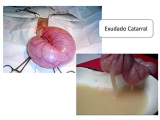 Exudado Catarral
 