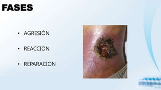 FASES
• AGRESIÓN
• REACCION
• REPARACION
 