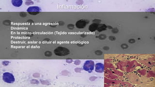 Inflamación
Respuesta a una agresión
Dinámica
En la micro-circulación (Tejido vascularizado)
Protectora
Destruir, aislar o diluir el agente etiológico
Reparar el daño
 