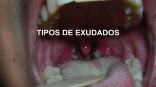 TIPOS DE EXUDADOS
 