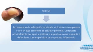 SEROSO
Se presenta en la inflamación moderada, el líquido es transparente
y con un bajo contenido de células y proteínas. Compuesto
principalmente por agua y proteína y se produce como respuesta a
daños leves o en etapa inicial de un proceso inflamatorio
 