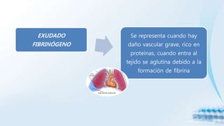 EXUDADO
FIBRINÓGENO
Se representa cuando hay
daño vascular grave, rico en
proteínas, cuando entra al
tejido se aglutina debido a la
formación de fibrina
 