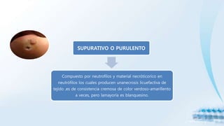SUPURATIVO O PURULENTO
Compuesto por neutrofilos y material necróticorico en
neutrófilos los cuales producen unanecrosis licuefactiva de
tejido ,es de consistencia cremosa de color verdoso-amarillento
a veces, pero lamayoría es blanquesino.
 