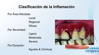 Clasificación de la Inflamación
Por Área Afectada:
Local
Regional
Difusa
Por Severidad:
Ligera
Moderada
Severa
Por Duración:
Agudas & Crónicas
 
