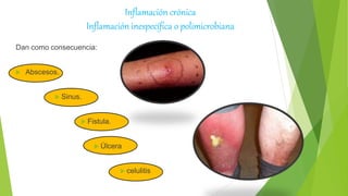 Inflamación crónica
Inflamación inespecífica o polimicrobiana
Dan como consecuencia:
 Abscesos.
 Sinus.
 Fistula.
 Úlcera
 celulitis
 
