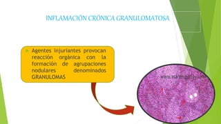 INFLAMACIÓN CRÓNICA GRANULOMATOSA
 Agentes injuriantes provocan
reacción orgánica con la
formación de agrupaciones
nodulares denominados
GRANULOMAS
 