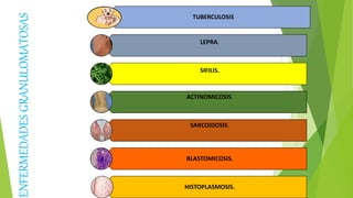 ENFERMEDADESGRANULOMATOSAS
TUBERCULOSIS
LEPRA.
SIFILIS.
ACTINOMICOSIS.
SARCOIDOSIS.
BLASTOMICOSIS.
HISTOPLASMOSIS.
 