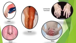 Dolor
Rubor
Tumor
Limitación
funcional
calor
 