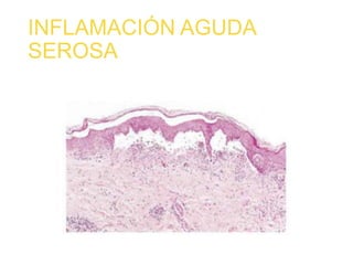INFLAMACIÓN AGUDA
SEROSA
 