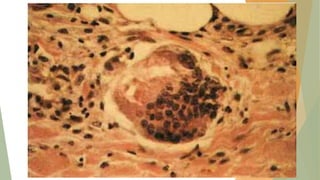 Activación de los
Macrófagos
 