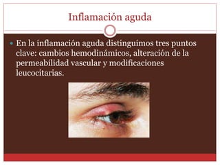 Inflamación aguda 
 En la inflamación aguda distinguimos tres puntos 
clave: cambios hemodinámicos, alteración de la 
permeabilidad vascular y modificaciones 
leucocitarias. 
 