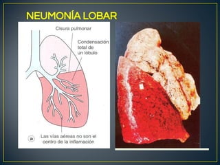 Lobulo Infectado INFLAMACIÓN AGUDA. MACROSCOPIA HFHFS.pdf