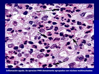 Inflamación aguda. Se aprecian PMN densamente agrupados con núcleos multinucleados 