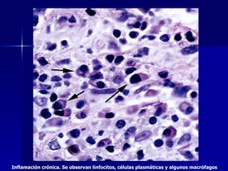 Inflamación crónica. Se observan linfocitos, células plasmáticas y algunos macrófagos   
