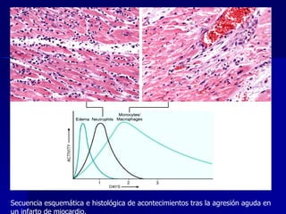Secuencia esquemática e histológica de acontecimientos tras la agresión aguda en un infarto de miocardio. 