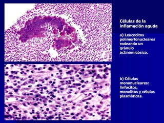 Células de la inflamación aguda a) Leucocitos polimorfonucleares rodeando un gránulo actinomicósico.  b) Células mononucleares: linfocitos, monolitos y células plasmáticas. 