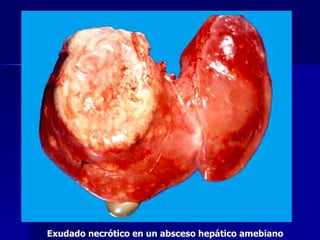 Exudado necrótico en un absceso hepático amebiano 