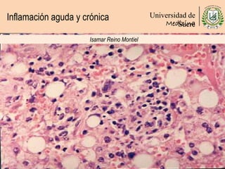 Inflamación aguda y crónica Universidad de
SucreMedicina
Isamar Reino Montiel
 