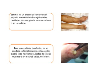 Edema: es un exceso de líquido en el 
espacio intersticial de los tejidos o las 
cavidades serosas; puede ser un exudado 
o un trasudado. 
Pus: un exudado purulento, es un 
exudado inflamatorio rico en leucocitos 
(sobre todo neutrófilos), restos de células 
muertas y, en muchos casos, microbios. 
 