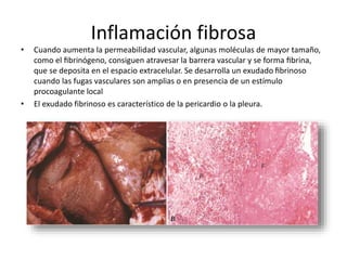Inflamación fibrosa 
• Cuando aumenta la permeabilidad vascular, algunas moléculas de mayor tamaño, 
como el fibrinógeno, consiguen atravesar la barrera vascular y se forma fibrina, 
que se deposita en el espacio extracelular. Se desarrolla un exudado fibrinoso 
cuando las fugas vasculares son amplias o en presencia de un estímulo 
procoagulante local 
• El exudado fibrinoso es característico de la pericardio o la pleura. 
 
