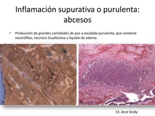 Inflamación supurativa o purulenta: 
abcesos 
• Producción de grandes cantidades de pus o exudado purulento, que contiene 
neutrófilos, necrosis licuefactiva y líquido de edema. 
 