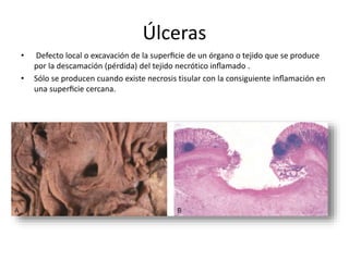 Úlceras 
• Defecto local o excavación de la superficie de un órgano o tejido que se produce 
por la descamación (pérdida) del tejido necrótico inflamado . 
• Sólo se producen cuando existe necrosis tisular con la consiguiente inflamación en 
una superficie cercana. 
 