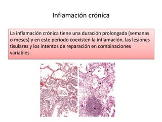 Inflamación crónica 
La inflamación crónica tiene una duración prolongada (semanas 
o meses) y en este período coexisten la inflamación, las lesiones 
tisulares y los intentos de reparación en combinaciones 
variables. 
 