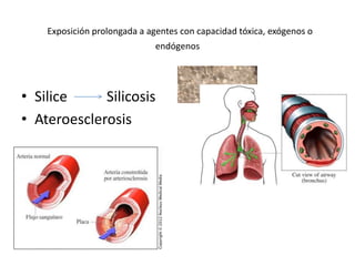 Exposición prolongada a agentes con capacidad tóxica, exógenos o 
endógenos 
• Silice Silicosis 
• Ateroesclerosis 
 