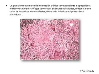 • Un granuloma es un foco de inflamación crónica correspondiente a agregaciones 
microscópicas de macrófagos convertidos en células epitelioides, rodeadas de un 
collar de leucocitos mononucleares, sobre todo linfocitos y algunas células 
plasmáticas . 
 
