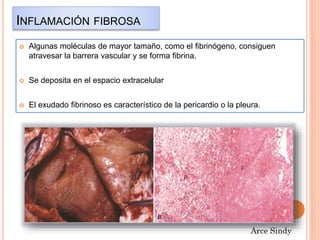 INFLAMACIÓN FIBROSA 
 Algunas moléculas de mayor tamaño, como el fibrinógeno, consiguen 
atravesar la barrera vascular y se forma fibrina. 
 Se deposita en el espacio extracelular 
 El exudado fibrinoso es característico de la pericardio o la pleura. 
 