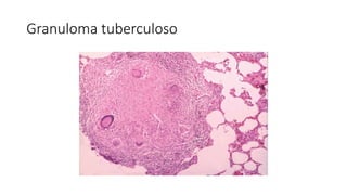 Granuloma tuberculoso
 