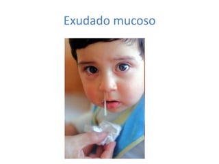 Exudado mucoso
 