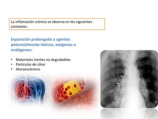 La inflamación crónica se observa en los siguientes
contextos:
Exposición prolongada a agentes
potencialmente tóxicos, exógenos o
endógenos:
• Materiales inertes no degradables
• Partículas de sílice
• Ateroesclerosis
 