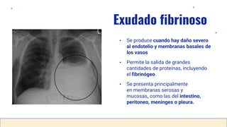 Exudado fibrinoso
• Se produce cuando hay daño severo
al endotelio y membranas basales de
los vasos
• Permite la salida de grandes
cantidades de proteínas, incluyendo
el fibrinógeo.
• Se presenta principalmente
en membranas serosas y
mucosas, como las del intestino,
peritoneo, meninges o pleura.
 