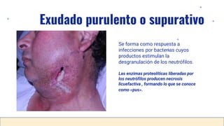 Exudado purulento o supurativo
Se forma como respuesta a
infecciones por bacterias cuyos
productos estimulan la
desgranulación de los neutrófilos.
Las enzimas proteolíticas liberadas por
los neutrófilos producen necrosis
licuefactiva , formando lo que se conoce
como «pus».
 