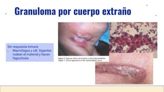 Granuloma por cuerpo extraño
Sin respuesta inmune
● Macrófagos y cél. Gigantes
rodean el material y hacen
fagocitosis
 