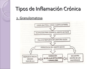Tipos de Inflamación Crónica 2. Granulomatosa 