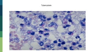 Tuberculosis
 