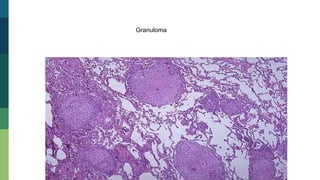 Granuloma
 