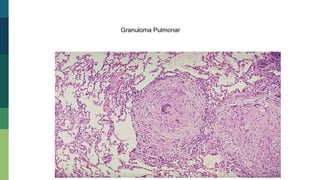 Granuloma Pulmonar
 