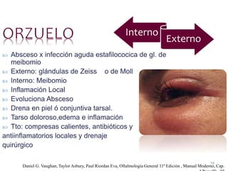 19
 Absceso x infección aguda estafilococica de gl. de
meibomio
 Externo: glándulas de Zeiss o de Moll
 Interno: Meibomio
 Inflamación Local
 Evoluciona Absceso
 Drena en piel ó conjuntiva tarsal.
 Tarso doloroso,edema e inflamación
 Tto: compresas calientes, antibióticos y
antiinflamatorios locales y drenaje
quirúrgico
Daniel G. Vaughan, Taylor Asbury, Paul Riordan Eva, Oftalmología General 11ª Edición , Manual Moderno, Cap.
Interno
Externo
 