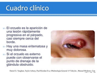  El orzuelo es la aparición de
una lesión rápidamente
progresiva en el párpado,
casi siempre cerca del
borde.
 Hay una masa eritematosa y
muy dolorosa.
 Si el orzuelo es externo
puede con observarse el
punto de drenaje de la
glándula obstruido.
Daniel G. Vaughan, Taylor Asbury, Paul Riordan Eva, Oftalmología General 11ª Edición , Manual Moderno, Cap.
 