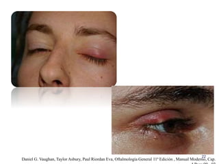 22
Daniel G. Vaughan, Taylor Asbury, Paul Riordan Eva, Oftalmología General 11ª Edición , Manual Moderno, Cap.
 