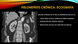 RADIOLOGIA ENFERMEDADES INFLAMATORIAS RENALES | PPTX